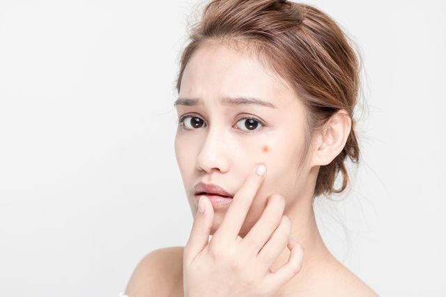 ニキビケアにおすすめのプチプラ化粧水*人気商品を比較!