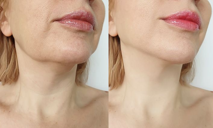 頬の脂肪吸引でおすすめのクリニック15選*人気の美容外科を紹介
