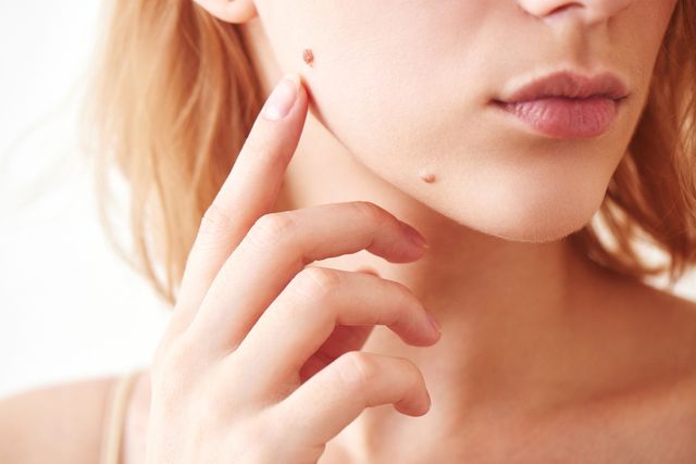 ほくろ除去のおすすめクリニック16選*イボ・ほくろ取りで人気の美容外科を紹介
