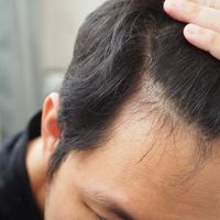 決定版 高校生の薄毛の原因と対策まとめ 若ハゲを絶対解決 自分らしい便利な暮らしを トラベルブック Travelbook