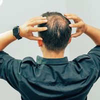 Agaの進行速度は タイプ別の若ハゲの違いについても解説 自分らしい便利な暮らしを トラベルブック Travelbook Agaの進行速度は タイプ別の若ハゲの違いについても解説 自分らしい便利な暮らしを トラベルブック Travelbook