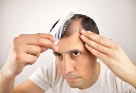 ミノキシジルは生え際にも効果あり 育毛効果や副作用も詳しく解説 トラブルブック